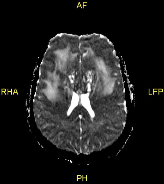 File:Butterfly glioma (Radiopaedia 76707-88526 Axial ADC 17).jpg