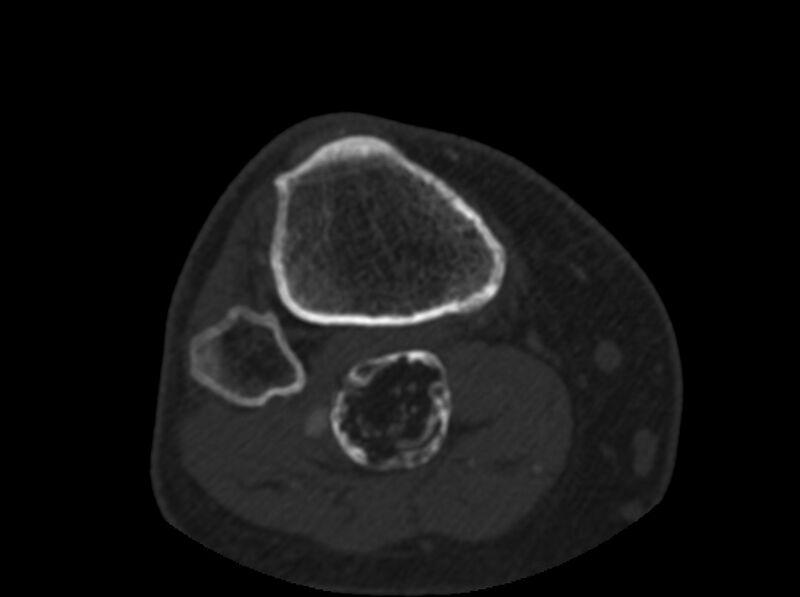 File:Calcified hematoma - popliteal fossa (Radiopaedia 63938-72763 C 77).jpg