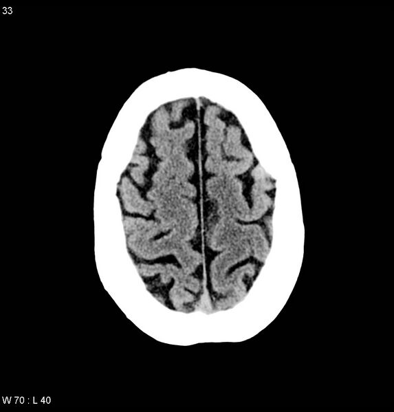 File:Calcified left middle cerebral artery embolism (Radiopaedia 5570-22120 Axial non-contrast 11).jpg