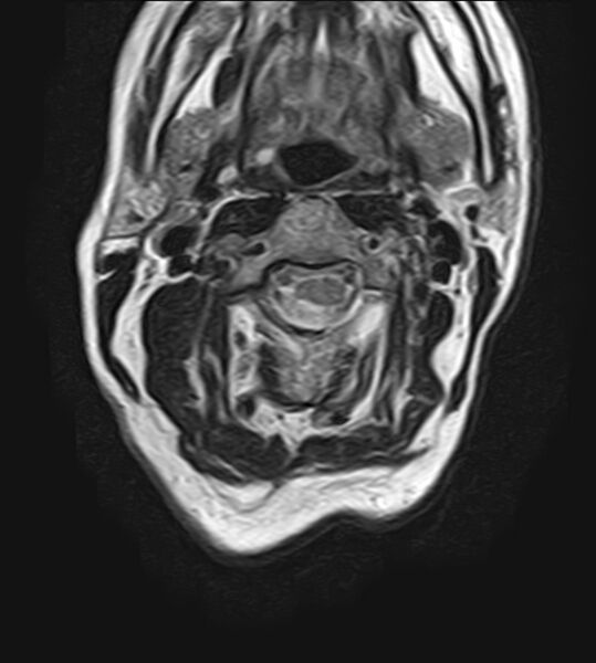 File:Calcified meningioma - cervical canal (Radiopaedia 70136-82468 Axial T2 12).jpg