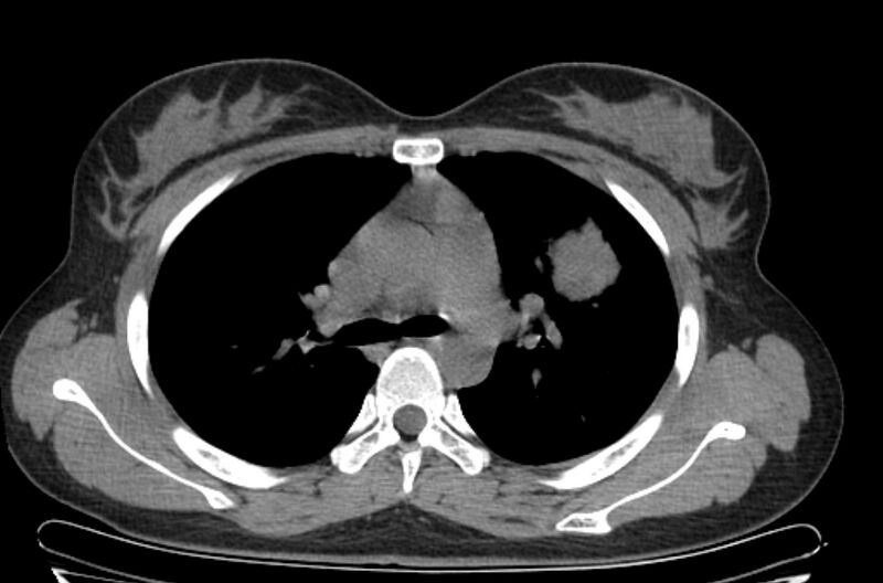 File:Cannonball metastases - uterine choriocarcinoma (Radiopaedia 70137-80173 Axial non-contrast 38).jpg