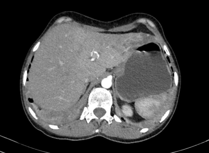 File:Cannonball metastases from breast cancer (Radiopaedia 91024-108569 A 112).jpg