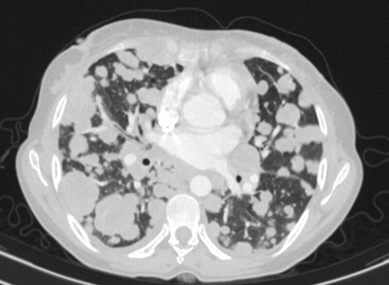 File:Cannonball metastases from breast cancer (Radiopaedia 91024-108569 Axial lung window 53).jpg