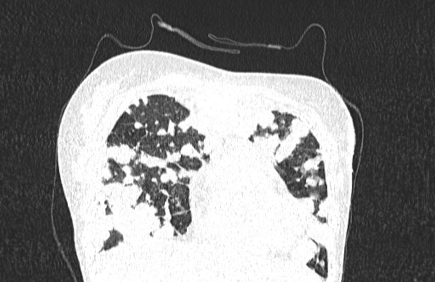 Cannonball metastases from breast cancer (Radiopaedia 91024-108569 Coronal lung window 27).jpg