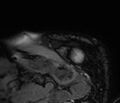 Cardiac amyloidosis (Radiopaedia 39736-42124 F 1).jpg