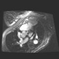 Cardiac fibroma (Radiopaedia 38974-41150 4 chamber FGRET 16).jpg