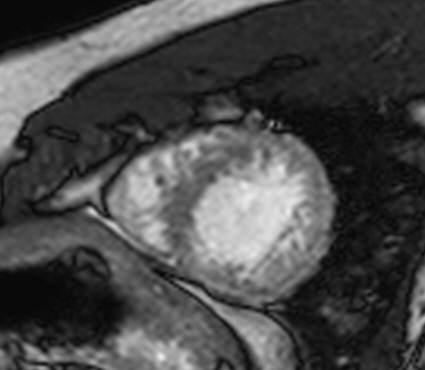 Cardiac sarcoidosis (Radiopaedia 39811-42243 I 126).jpg