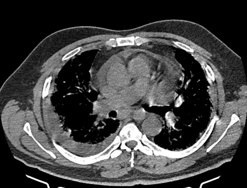 File:Cardiogenic pulmonary edema (Radiopaedia 68180-77678 Axial non-contrast 22).jpg