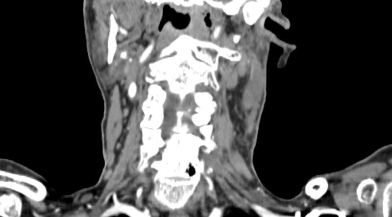 File:Carotid artery pseudoaneurysm (Radiopaedia 84030-99259 D 60).jpg