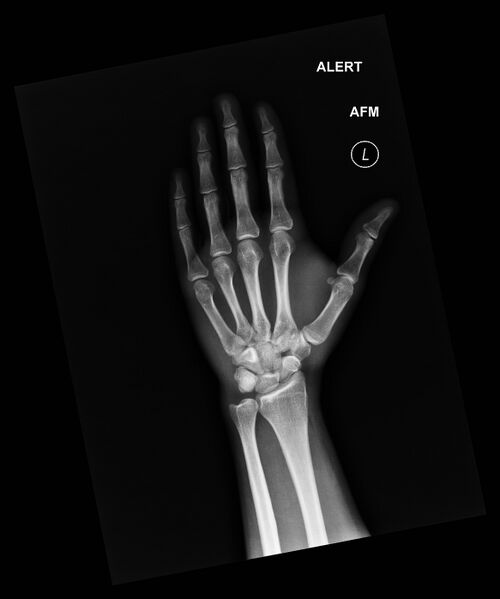 File:Carpal fractures (smart watch impaction) (Radiopaedia 55844-62429 Frontal 1).jpg
