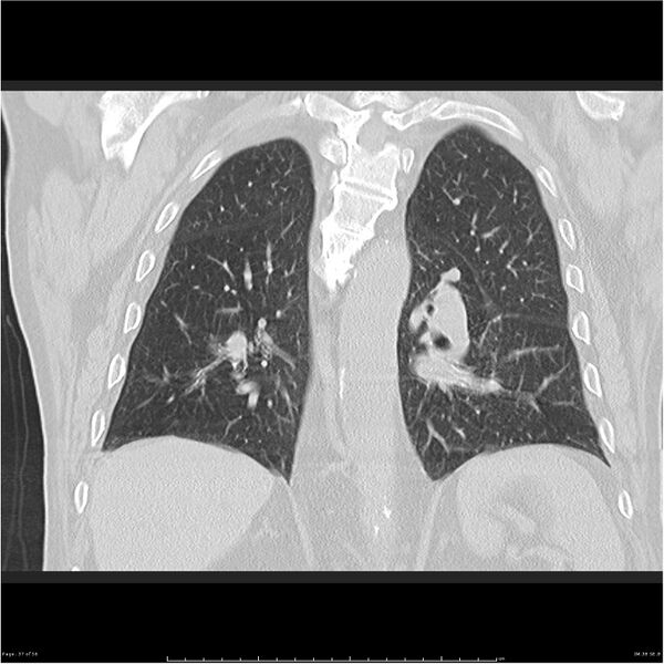 File:Cavitating left lower lobe lesion - squamous cell lung cancer (Radiopaedia 27749-28176 Coronal lung window 37).jpg