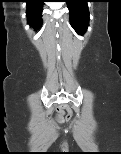 File:Cecum hernia through the foramen of Winslow (Radiopaedia 46634-51112 B 41).png