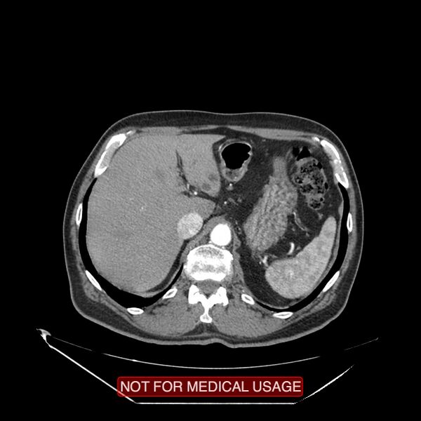 File:Celiac trunk variant anatomy - gastrohepatic trunk and splenic artery (Radiopaedia 38815-40995 A 6).jpg