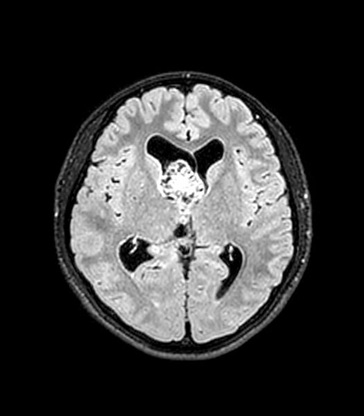 File:Central neurocytoma (Radiopaedia 79320-92380 Axial FLAIR 156).jpg