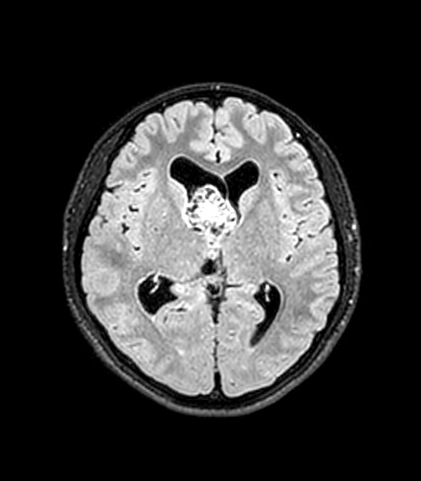 Central neurocytoma (Radiopaedia 79320-92380 Axial FLAIR 156).jpg