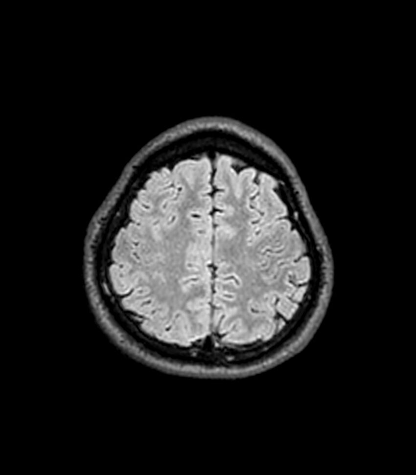 Central neurocytoma (Radiopaedia 79320-92380 Axial FLAIR 72).jpg