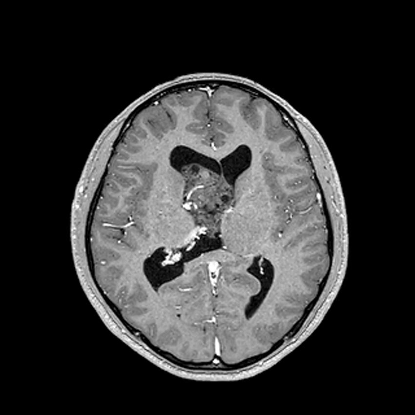 Central neurocytoma (Radiopaedia 79320-92380 Axial T1 C+ 134).jpg
