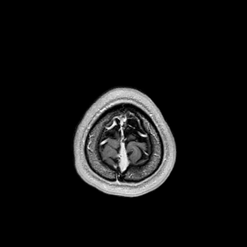Central neurocytoma (Radiopaedia 79320-92380 Axial T1 C+ 218).jpg
