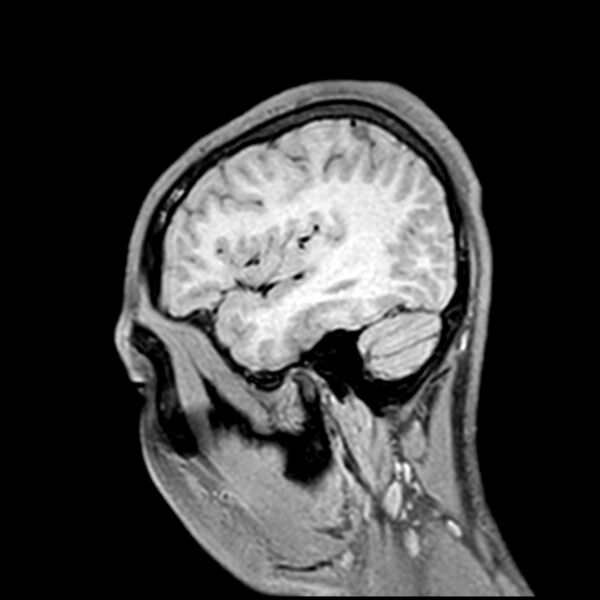 File:Central neurocytoma (Radiopaedia 79320-92380 Sagittal T1 206).jpg