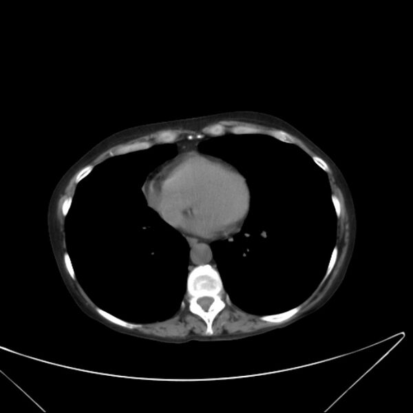 File:Centrilobular pulmonary emphysema (Radiopaedia 24495-24789 Axial non-contrast 33).jpg