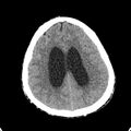 Cerebellar abscess secondary to mastoiditis (Radiopaedia 26284-26412 Axial non-contrast 114).jpg