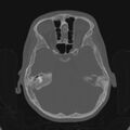Cerebellar abscess secondary to mastoiditis (Radiopaedia 26284-26413 Axial bone window 68).jpg