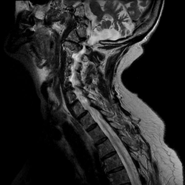 File:Cerebellar ataxia with neuropathy and vestibular areflexia syndrome (CANVAS) (Radiopaedia 74283-85159 Sagittal T2 3).jpg