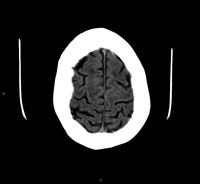 File:Cerebellar hemorrhage (Radiopaedia 58792-66026 Axial non-contrast 9).jpg