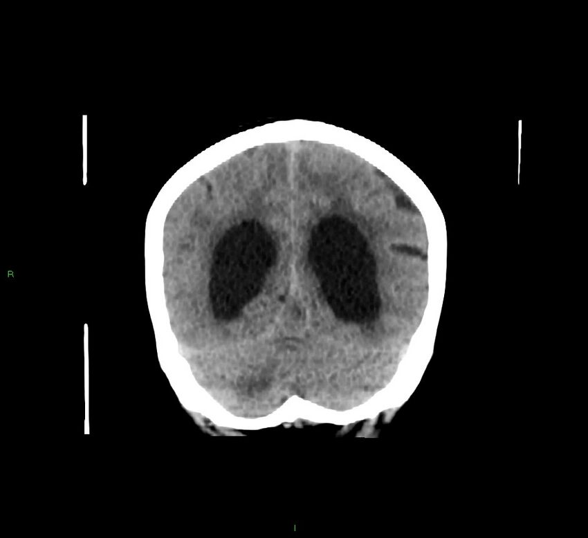 Cerebellar hemorrhage (Radiopaedia 58793-66027 Coronal non-contrast 22).jpg
