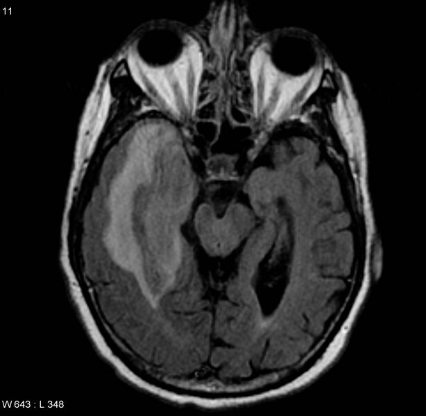 File:Cerebral abscess and ventriculitis (Radiopaedia 5024-6885 Axial FLAIR 1).jpg