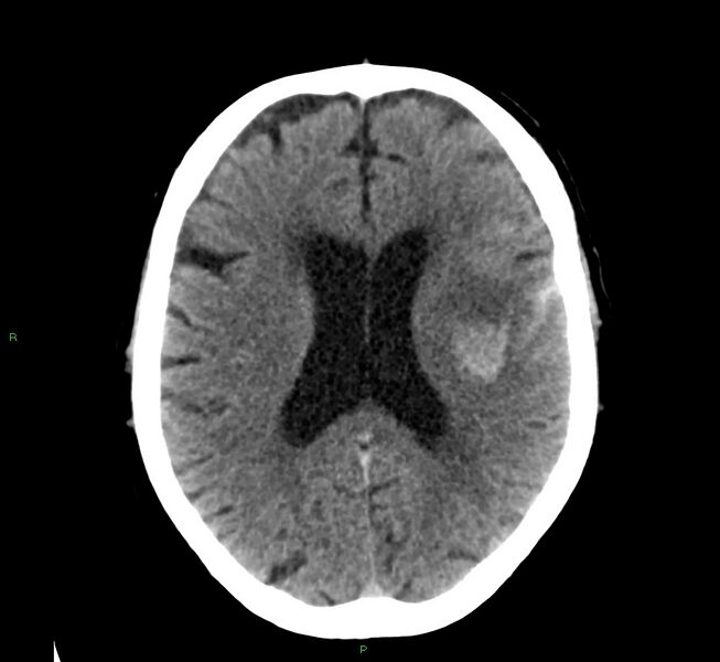 File:Cerebral amyloid angiopathy-associated lobar intracerebral hemorrhage (Radiopaedia 58376-65511 Axial non-contrast 25).jpg