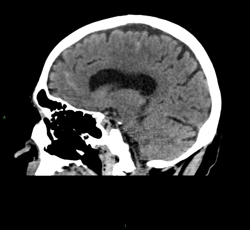 Cerebral amyloid angiopathy-associated lobar intracerebral hemorrhage (Radiopaedia 58376-65511 C 31).jpg