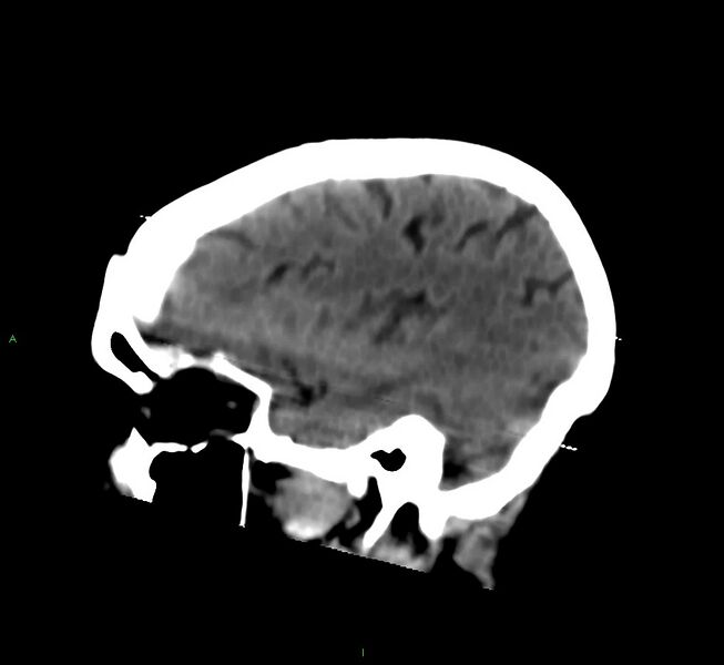 File:Cerebral amyloid angiopathy-associated lobar intracerebral hemorrhage (Radiopaedia 58377-65514 B 38).jpg