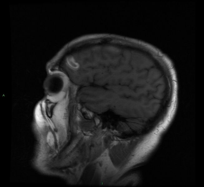 File:Cerebral amyloid angiopathy-associated lobar intracerebral hemorrhage (Radiopaedia 58529-65684 Sagittal T1 19).jpg