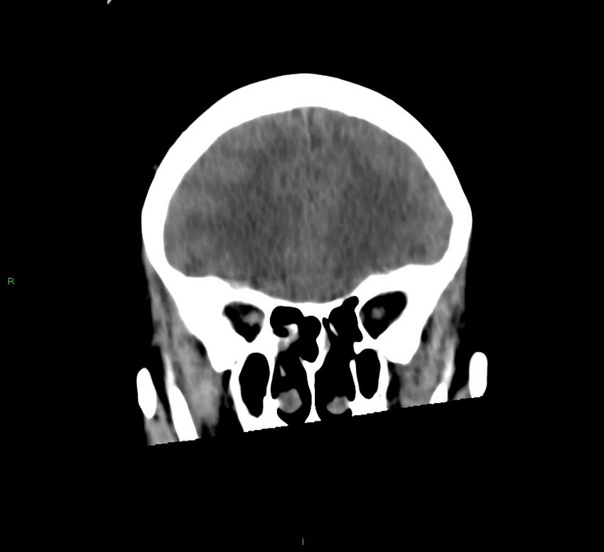 Cerebral amyloid angiopathy-associated lobar intracerebral hemorrhage (Radiopaedia 58566-65730 Coronal non-contrast 52).jpg