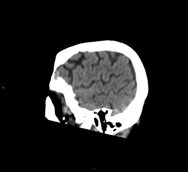 File:Cerebral amyloid angiopathy-associated lobar intracerebral hemorrhage (Radiopaedia 58758-65980 C 45).jpg