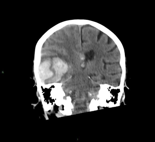 File:Cerebral amyloid angiopathy-associated lobar intracerebral hemorrhage (Radiopaedia 58758-65980 Coronal non-contrast 29).jpg