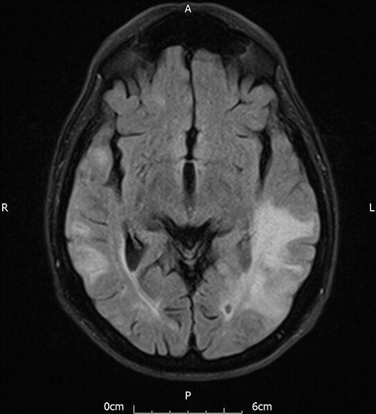 File:Cerebral amyloid angiopathy related inflammation (Radiopaedia 72772-83415 Axial FLAIR 11).jpg