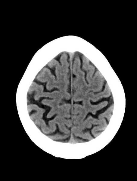 File:Cerebral aneurysm with rupture (Radiopaedia 29933-30457 Axial non-contrast 22).jpg