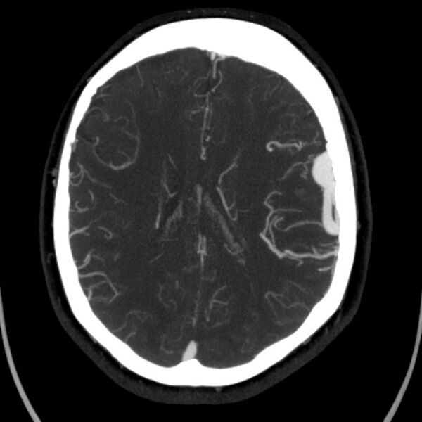 File:Cerebral arteriovenous malformation (Radiopaedia 43729-47189 B 31).jpg