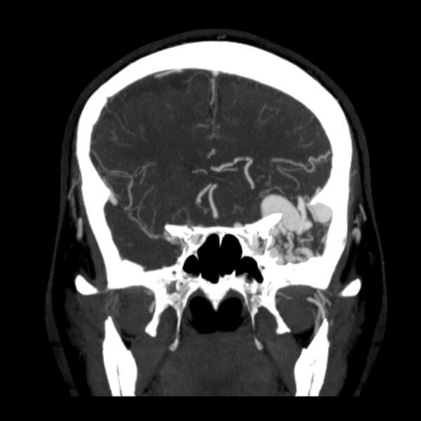 File:Cerebral arteriovenous malformation (Radiopaedia 43729-47189 C 16).jpg