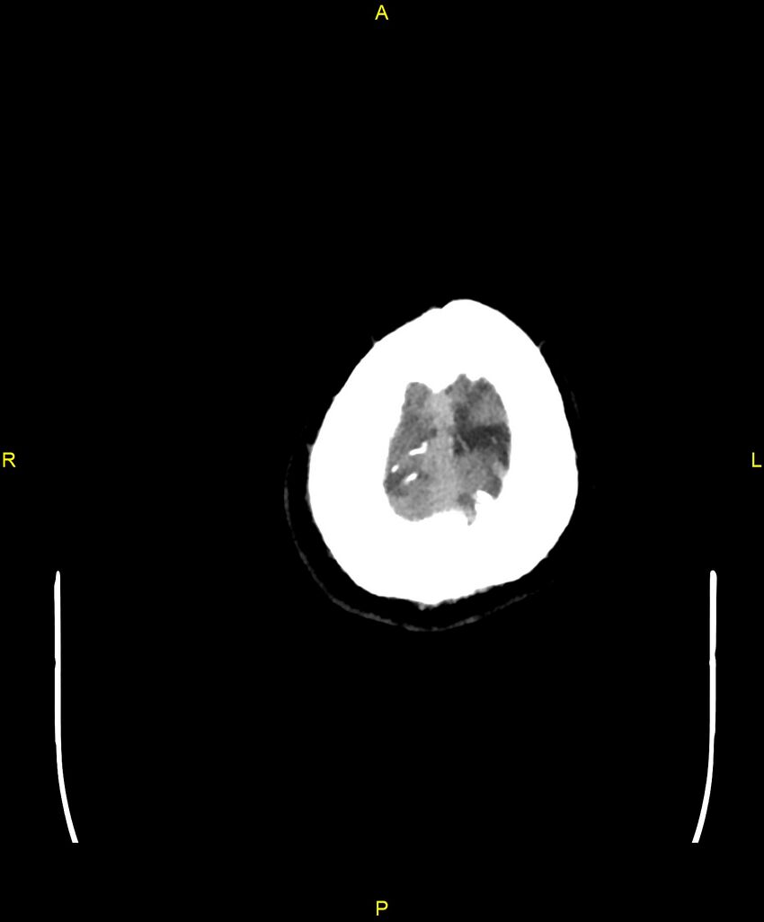 Cerebral autosomal dominant arteriopathy with subcortical infarcts and leukoencephalopathy (CADASIL) (Radiopaedia 86108-102051 Axial non-contrast 111).jpg