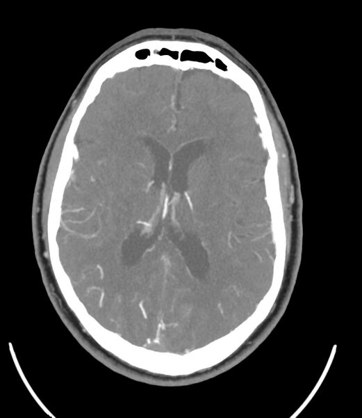 File:Cerebral dural venous sinus thrombosis (Radiopaedia 86514-102576 A 61).jpg