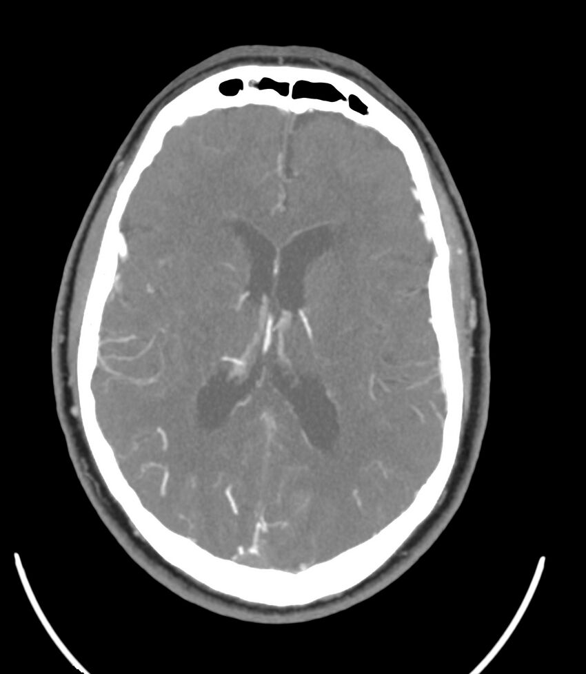 Cerebral dural venous sinus thrombosis (Radiopaedia 86514-102576 A 61).jpg