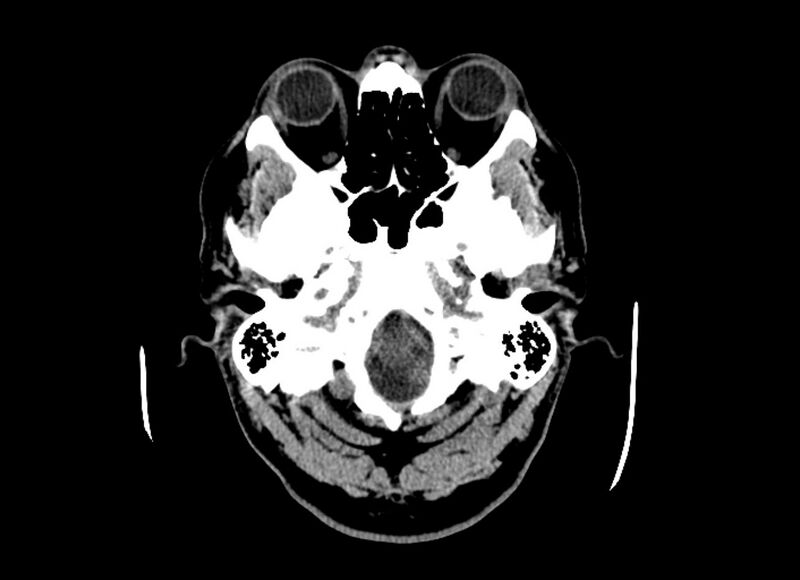 File:Cerebral edema (Radiopaedia 82519-96661 Axial non-contrast 48).jpg