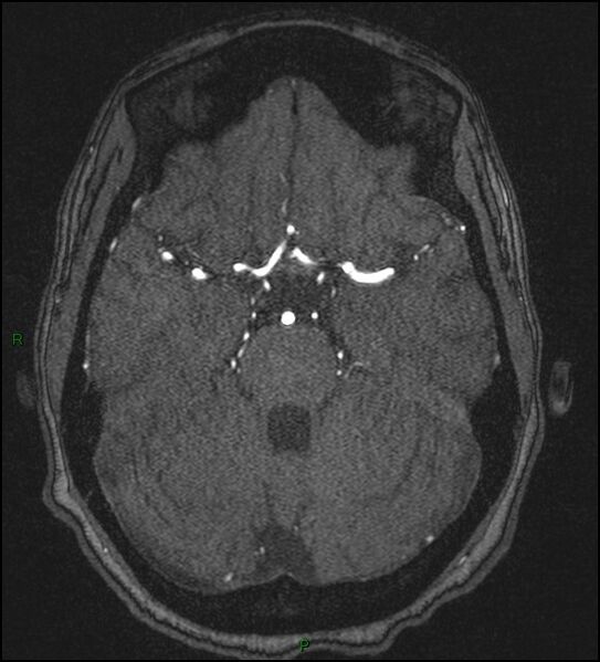 File:Cerebral fat embolism (Radiopaedia 35022-36525 Axial TOF 67).jpg