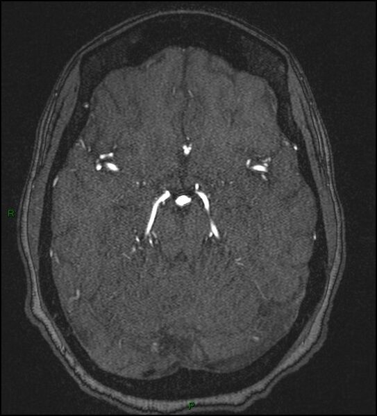 File:Cerebral fat embolism (Radiopaedia 35022-36525 Axial TOF 77).jpg