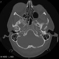 Cerebral hemorrhagic contusion with subdural and subarachnoid hemorrhage (Radiopaedia 10680-11146 Axial bone window 7).jpg