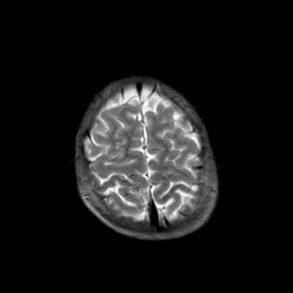File:Cerebral tuberculoma (Radiopaedia 41152-43932 Axial T2 20).jpg