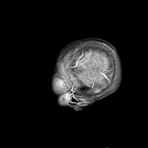 File:Cerebral tuberculoma (Radiopaedia 41152-43932 Sagittal T1 C+ 1).jpg